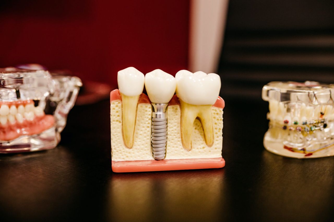 Les différents types de restauration dentaire